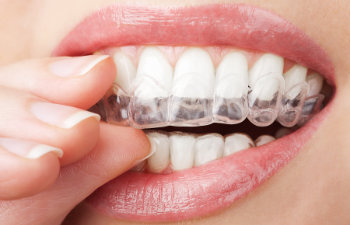 woman puts on invisalign close up on lips 1